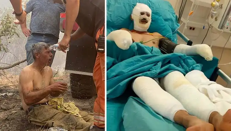Orman İşçisinin Korkunç Yangın Dramı: 'Yanıyorum' Feryadı Duyuldu