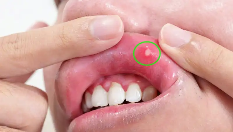 Vücudunuzun Fark Etmediği 5 B Vitamini Eksikliği Belirtisi